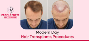 Are modern hair transplants different from traditional ones?